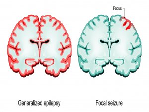 Epilepsy/Seizures KNOW MORE