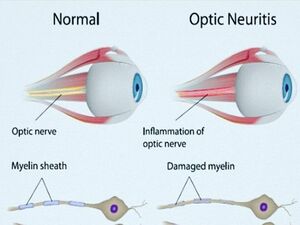Optic Neuritis KNOW MORE