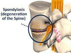 Spondylosis Lumbar KNOW MORE