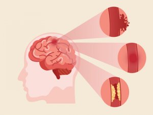 Stroke / Paralysis KNOW MORE