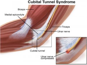 Tunnel Syndrome KNOW MORE