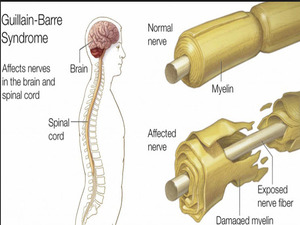 GB Syndrome KNOW MORE